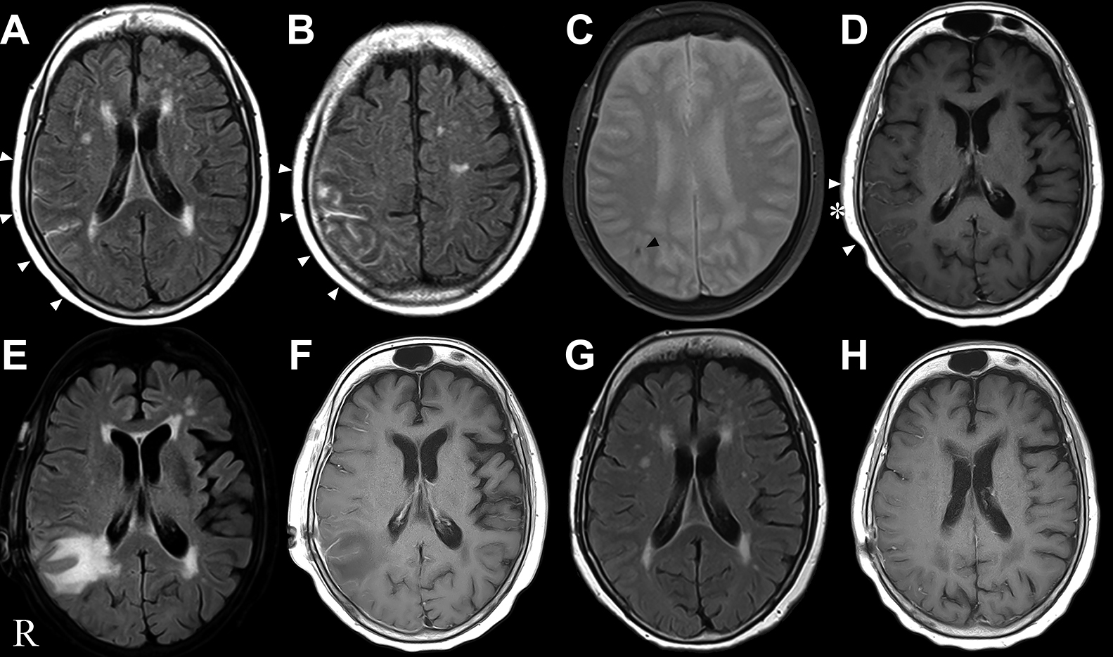 脳生検後に白質病変を呈し，未治療で病変が改善した脳アミロイドアンギオパチーの2例