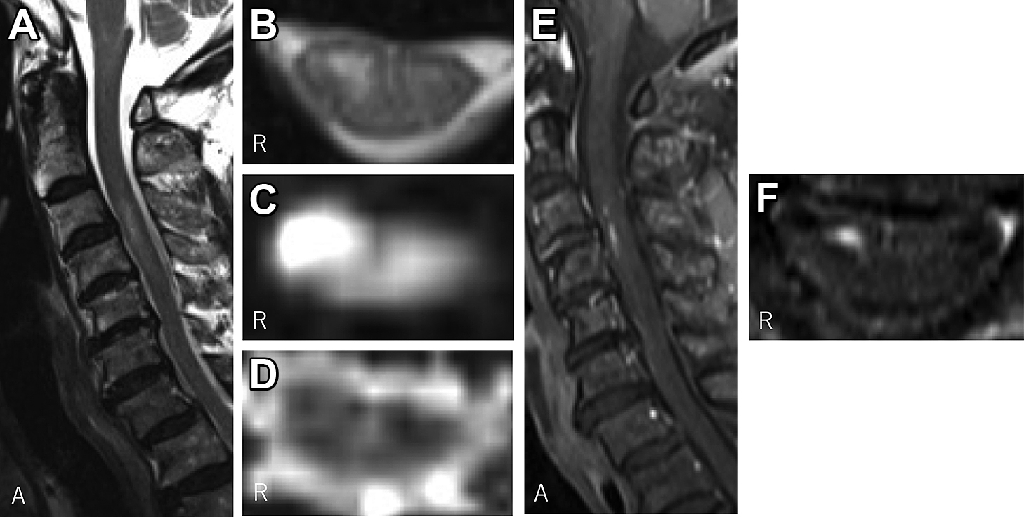 A case of spinal cord infarction presenting with unilateral C5 palsy