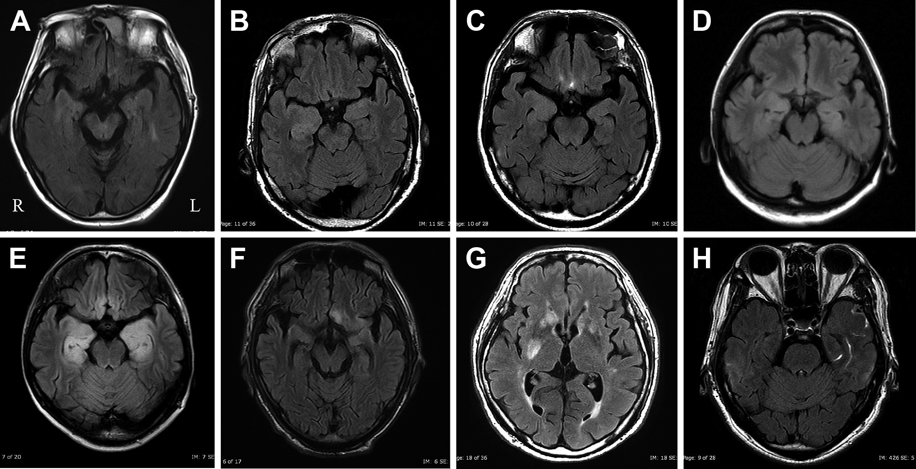 てんかん発作を主徴とした自己免疫性脳炎の臨床的特徴と早期治療におけるスコアリングの有用性の検討