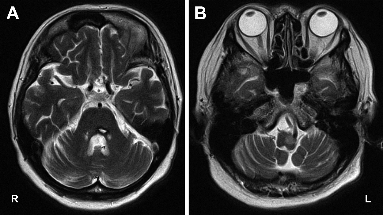 <sup>123</sup>I-IMP SPECTとMRIの所見から小脳視床路と歯状核赤核オリーブ路の障害が示唆されたHolmes振戦の1例