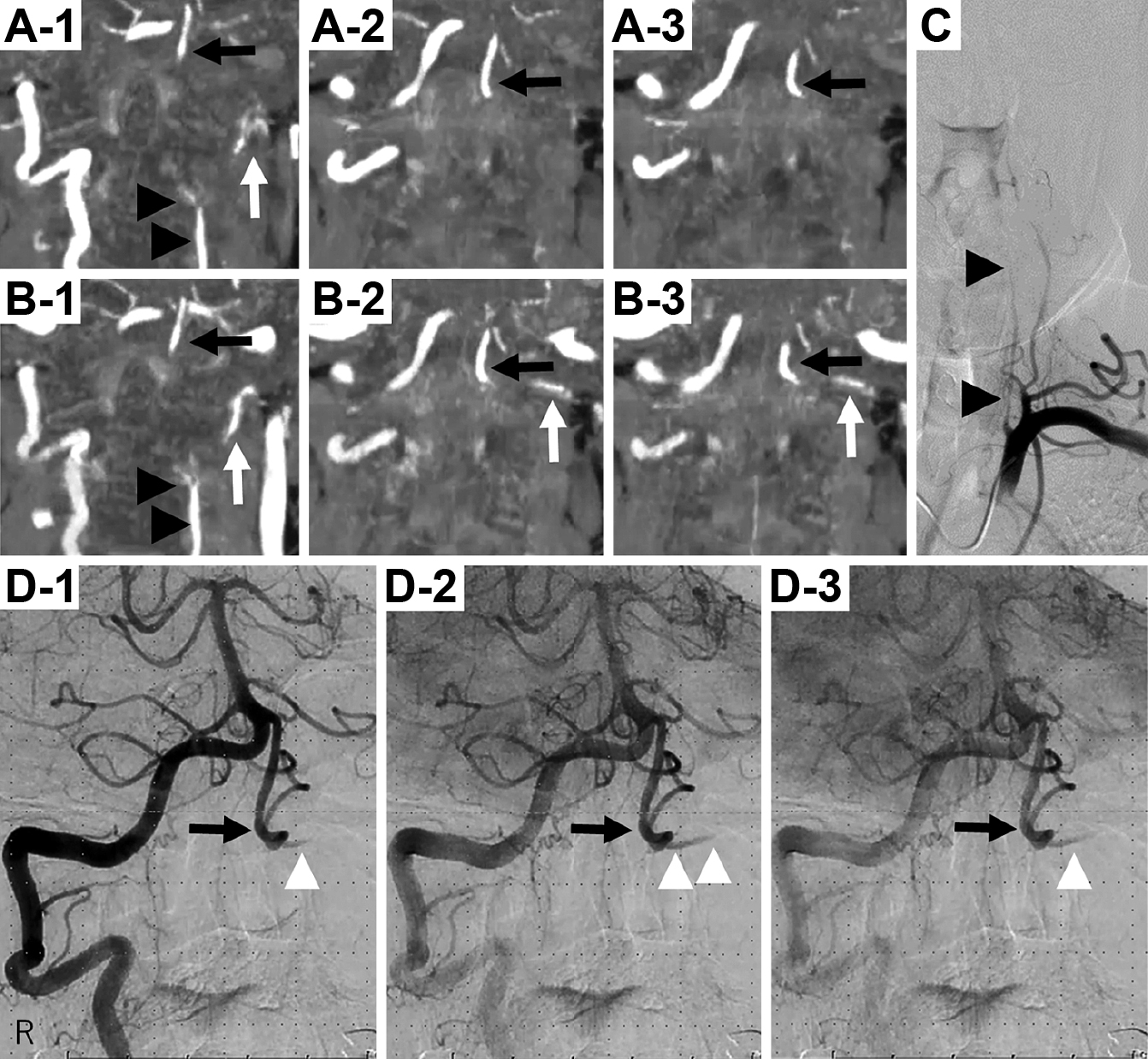 CTアンギオグラフィーによってvertebral artery stump syndromeを疑った1例