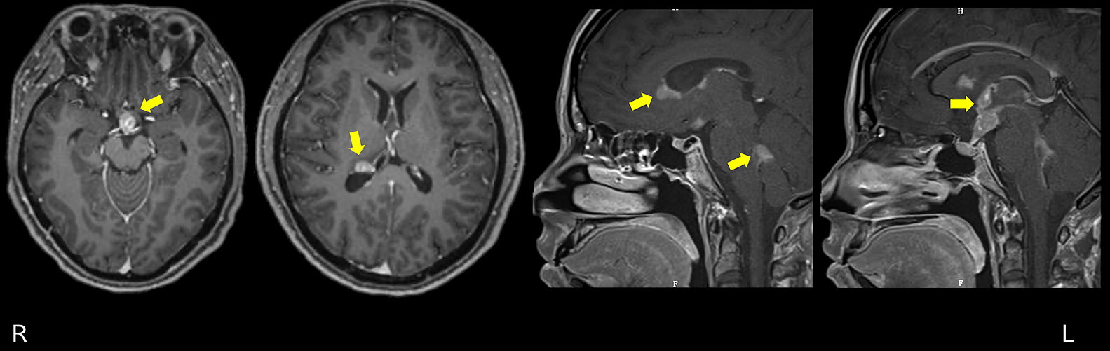 汎下垂体機能低下症にて発症した中枢神経系原発悪性リンパ腫の1例