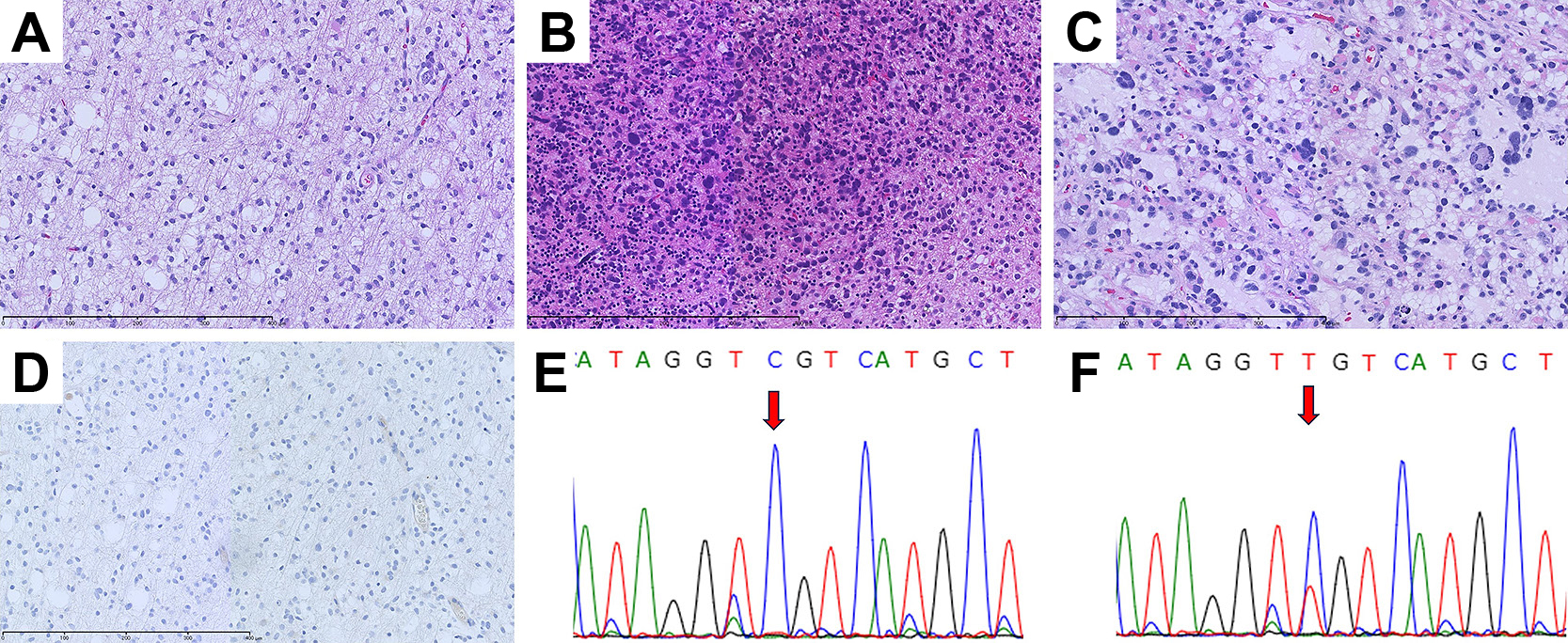 IDH1 p.R132C変異を有し進行性に悪性転化したOllier病合併多発神経膠腫の1例