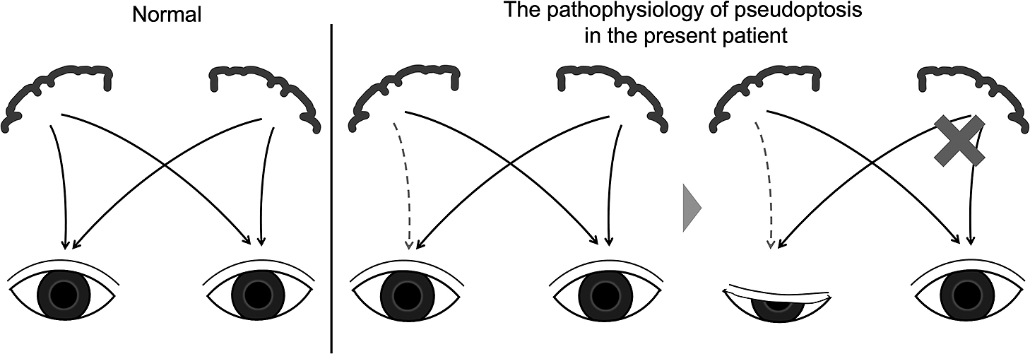 A case of lenticulostriate artery infarction presenting with peripheral type facial palsy