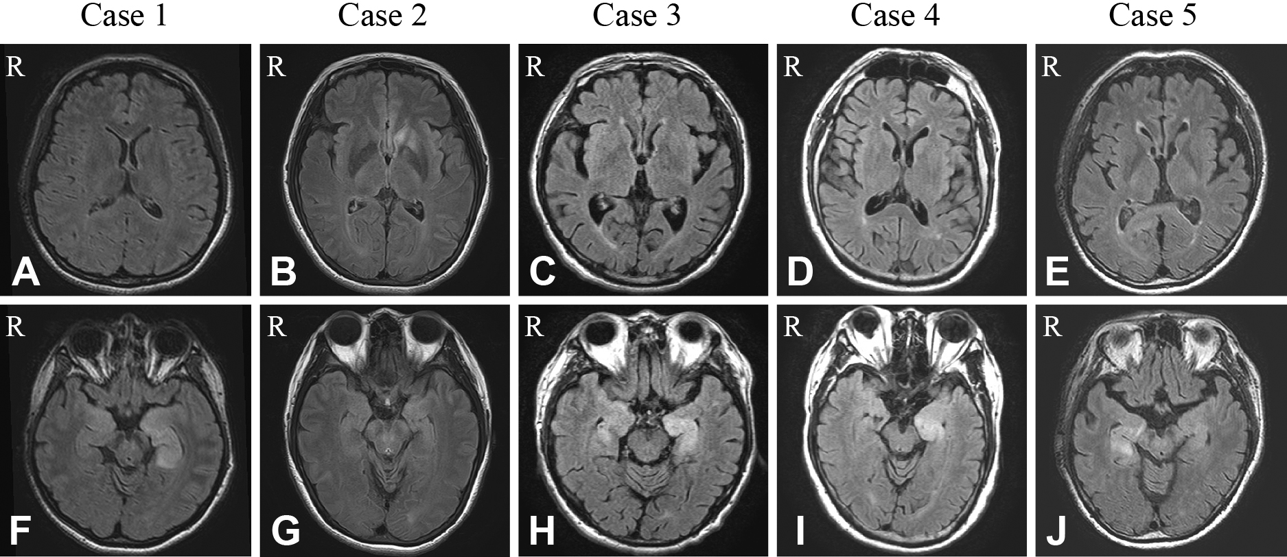 当院で経験したleucine-rich glioma-inactivated 1（LGI1）抗体陽性脳炎の臨床的特徴