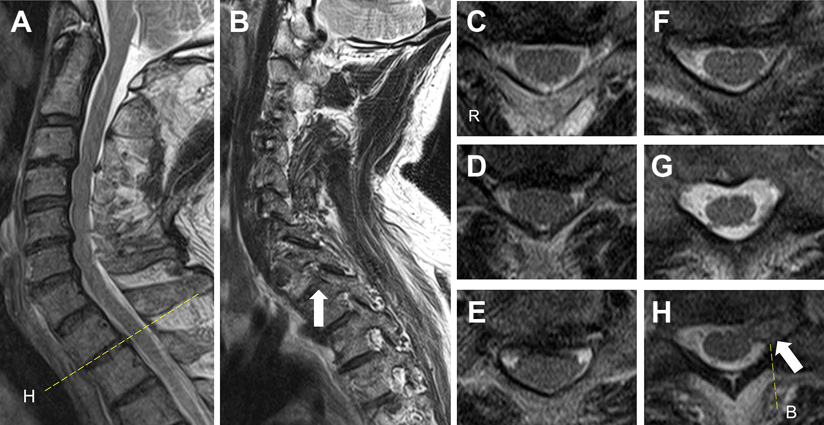 Cervical anginaを呈した椎間板ヘルニアによるT1神経根症の1例