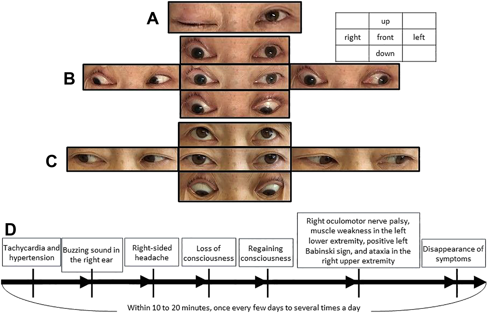 Meningeal carcinomatosis causing paroxysmal and reversible right midbrain symptoms: a case report