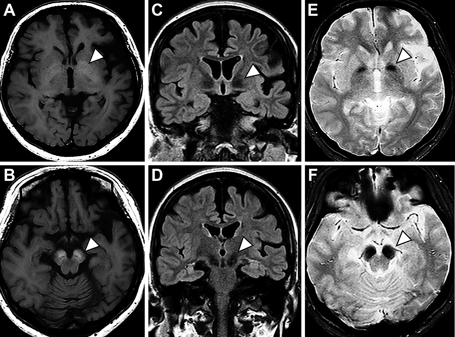 Asymmetrical parkinsonism due to novel <i>WDR45</i> variant with beta-propeller protein-associated neurodegeneration (BPAN)