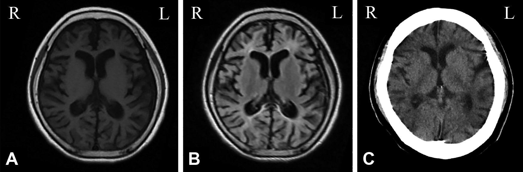 ラモトリギン中止およびスチリペントール投与で発作増悪したDravet症候群の成人例