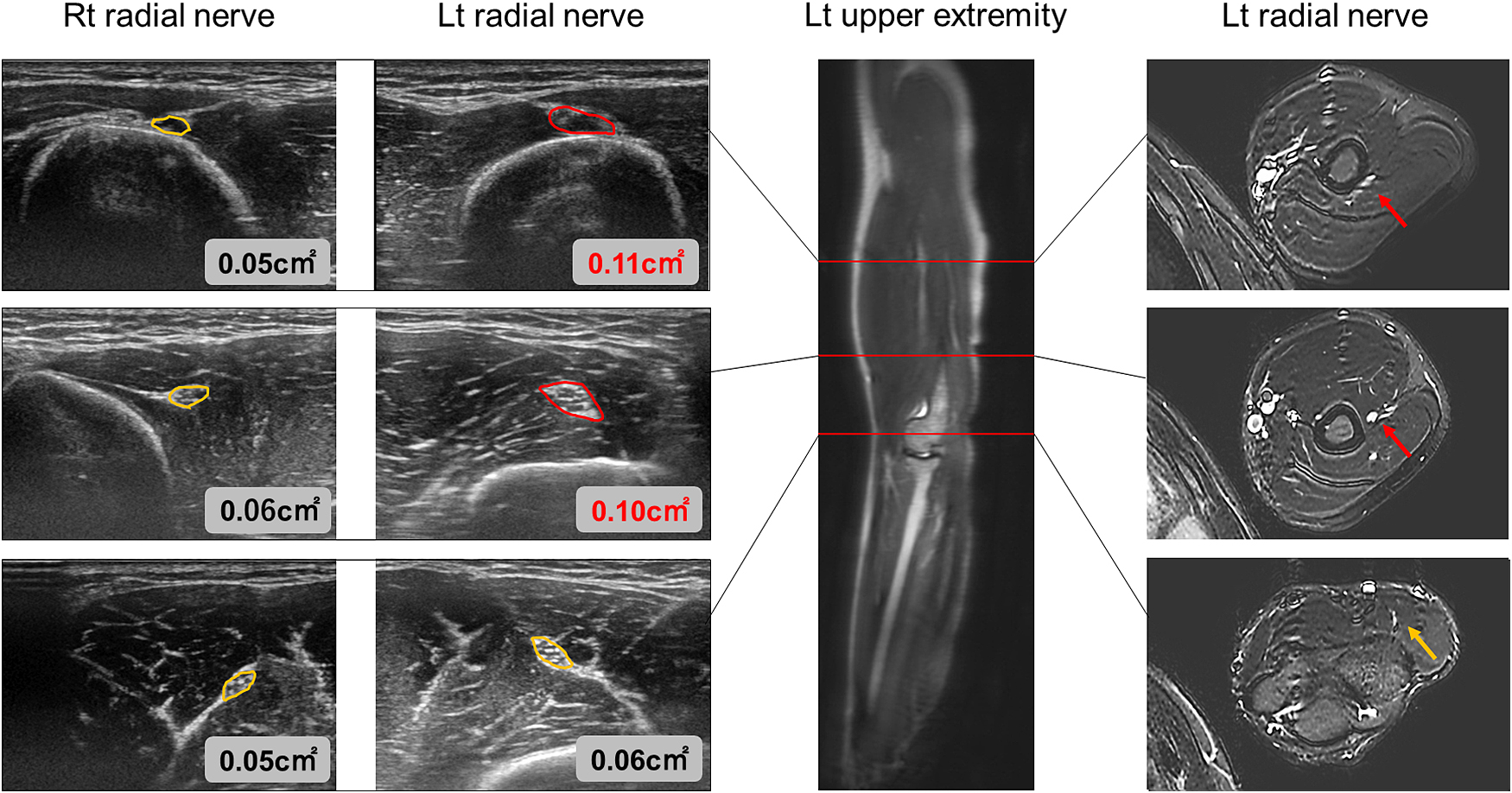 後骨間神経麻痺が疑われたpossible multifocal motor neuropathyの1例