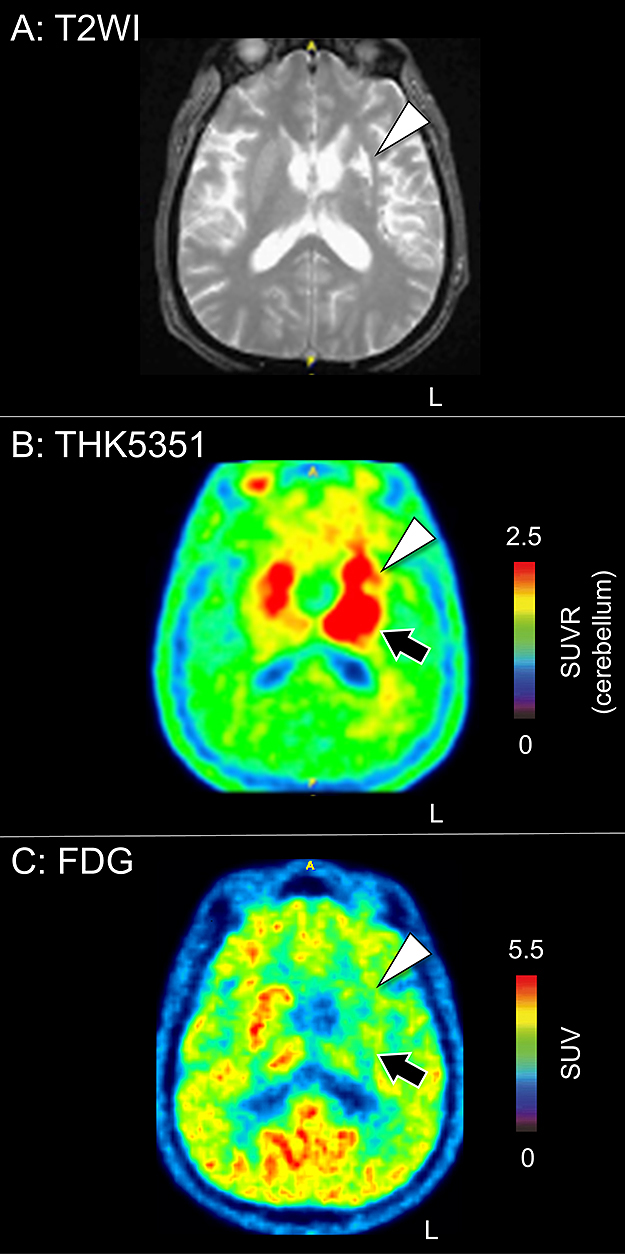 Meningovascular and parenchymal neurosyphilis showing more extensive inflammatory lesions on <sup>18</sup>F-THK5351 PET than MRI