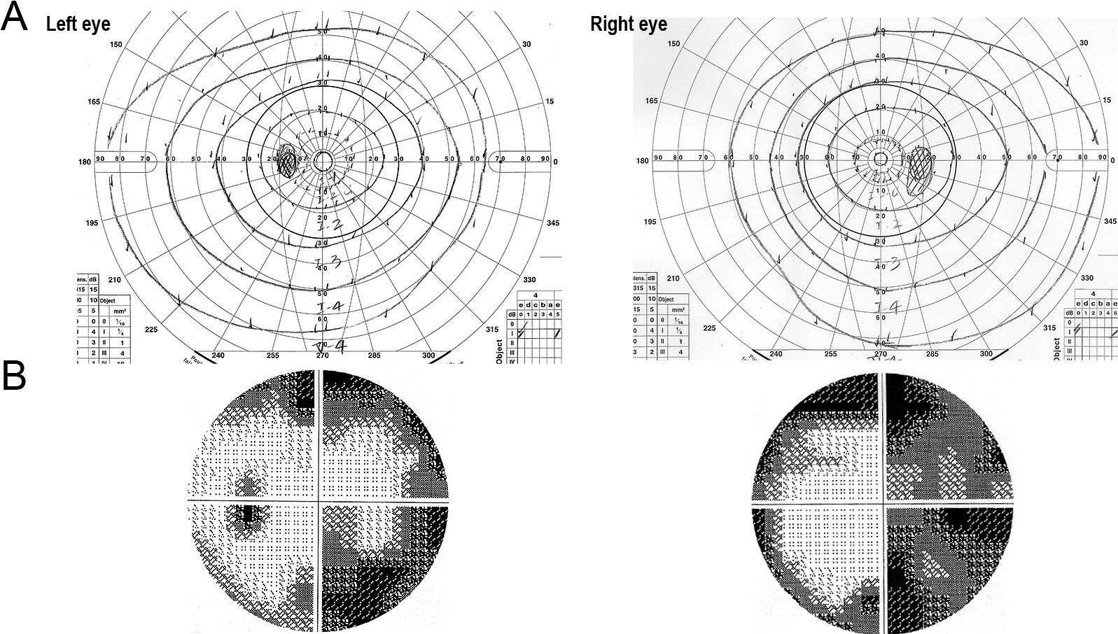 漢字優位の失書で発症し，静的動的視野解離（Riddoch現象）を認めたposterior cortical atrophyの1例
