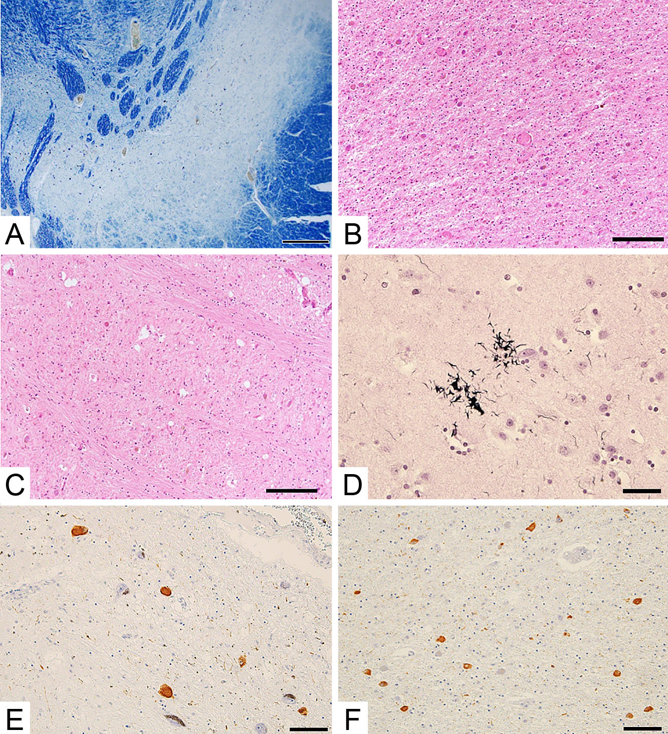 首下がりで発症し，pure akinesia with gait freezingの臨床像を呈した進行性核上性麻痺の76歳女性剖検例