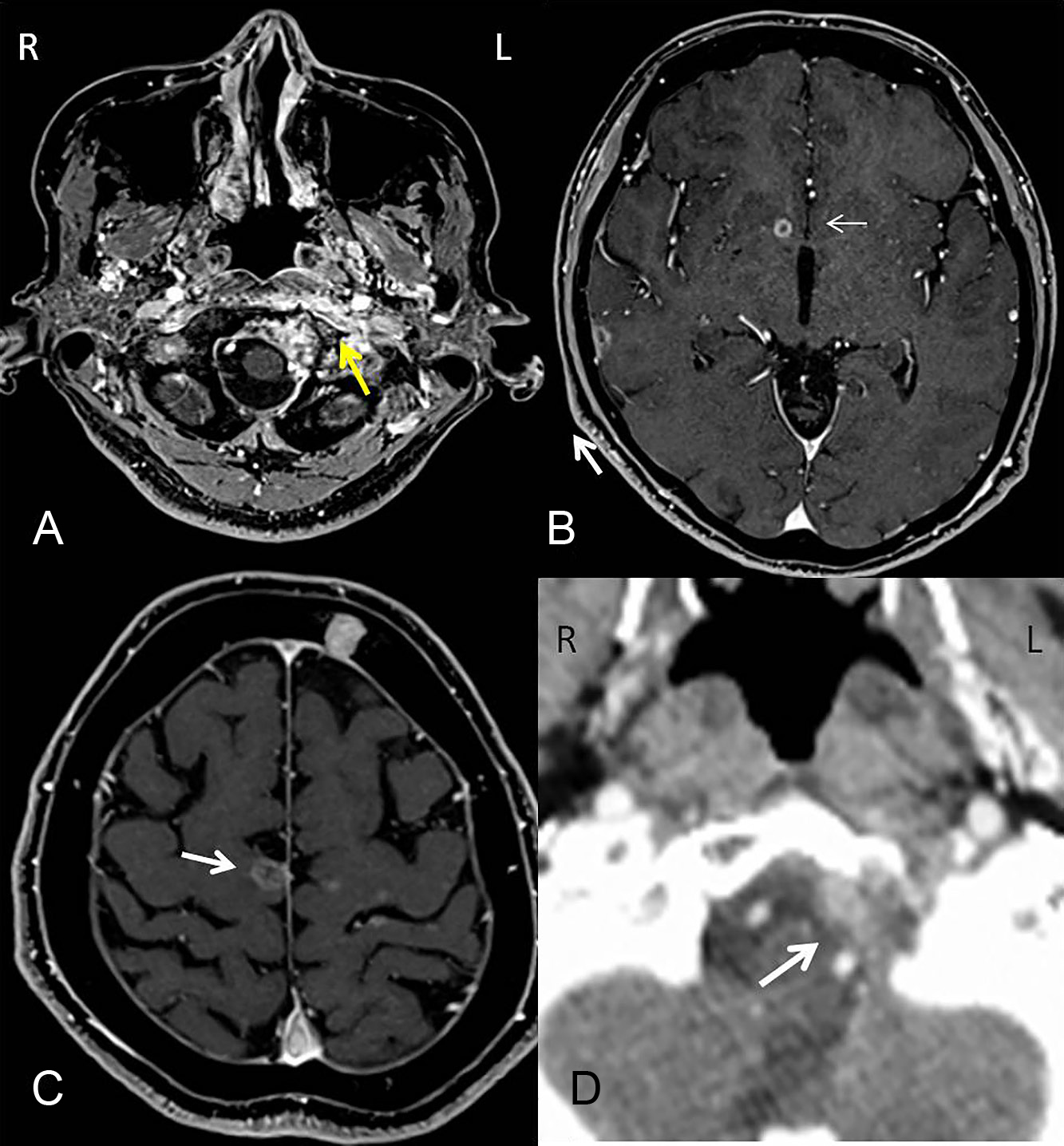 オシメルチニブが著効した肺腺癌転移による後頭顆症候群の1例