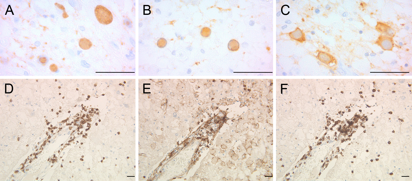 関節リウマチを背景に発症した非薬剤性進行性多巣性白質脳症の1剖検例