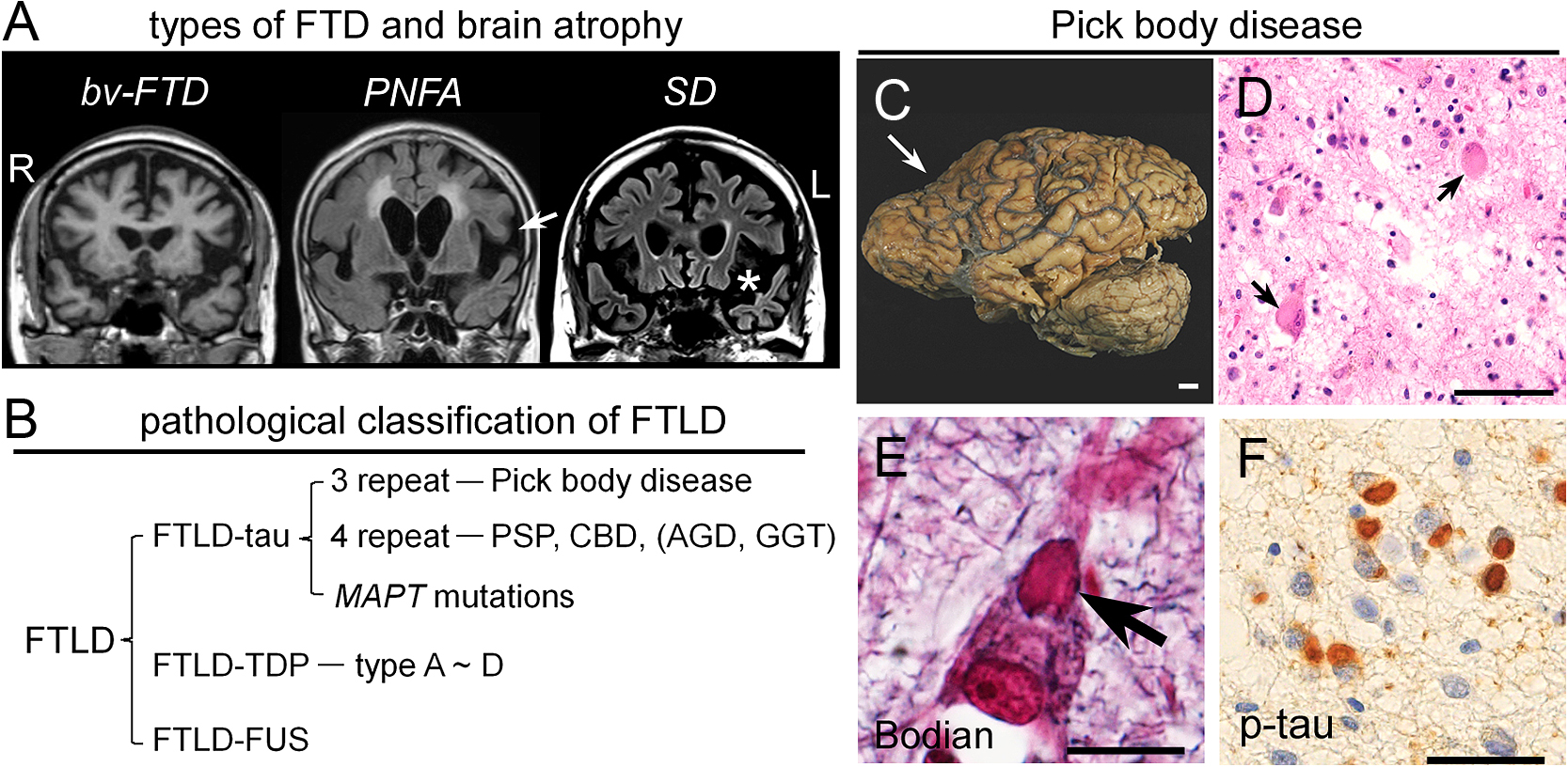 臨床神経病理から考える前頭側頭葉変性症の病態