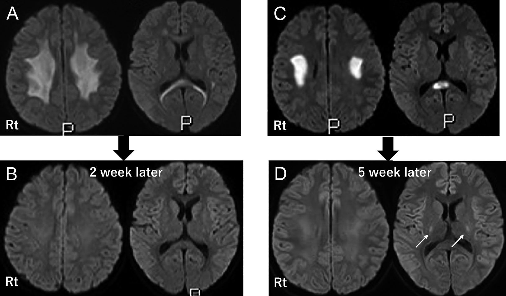 免疫治療に反応を認める末梢神経障害を呈したものの繰り返す脳病変の存‍在からX連鎖性Charcot–Marie–Tooth病1型（CMTX1）と診断された1例