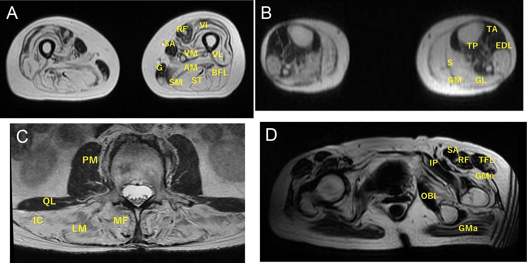 Filamin C actin-binding domainのノンシノニマス変異によるミオパチーの一家系