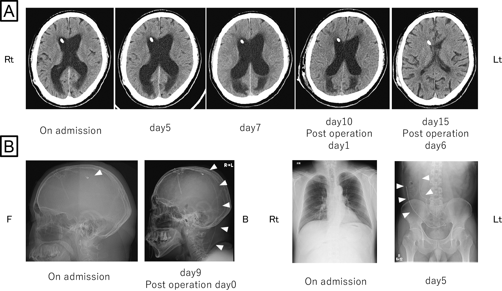 脳室－腹腔シャント分離により意識障害を来し，胸部および腹部レントゲンが診断に有用であった1例