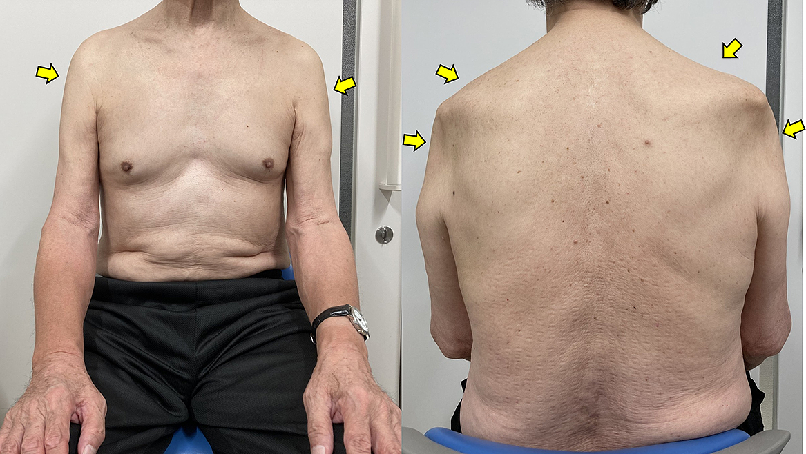 左右差の強い近位筋優位の筋萎縮を伴う末梢神経障害を呈した成人型Krabbe病の1例