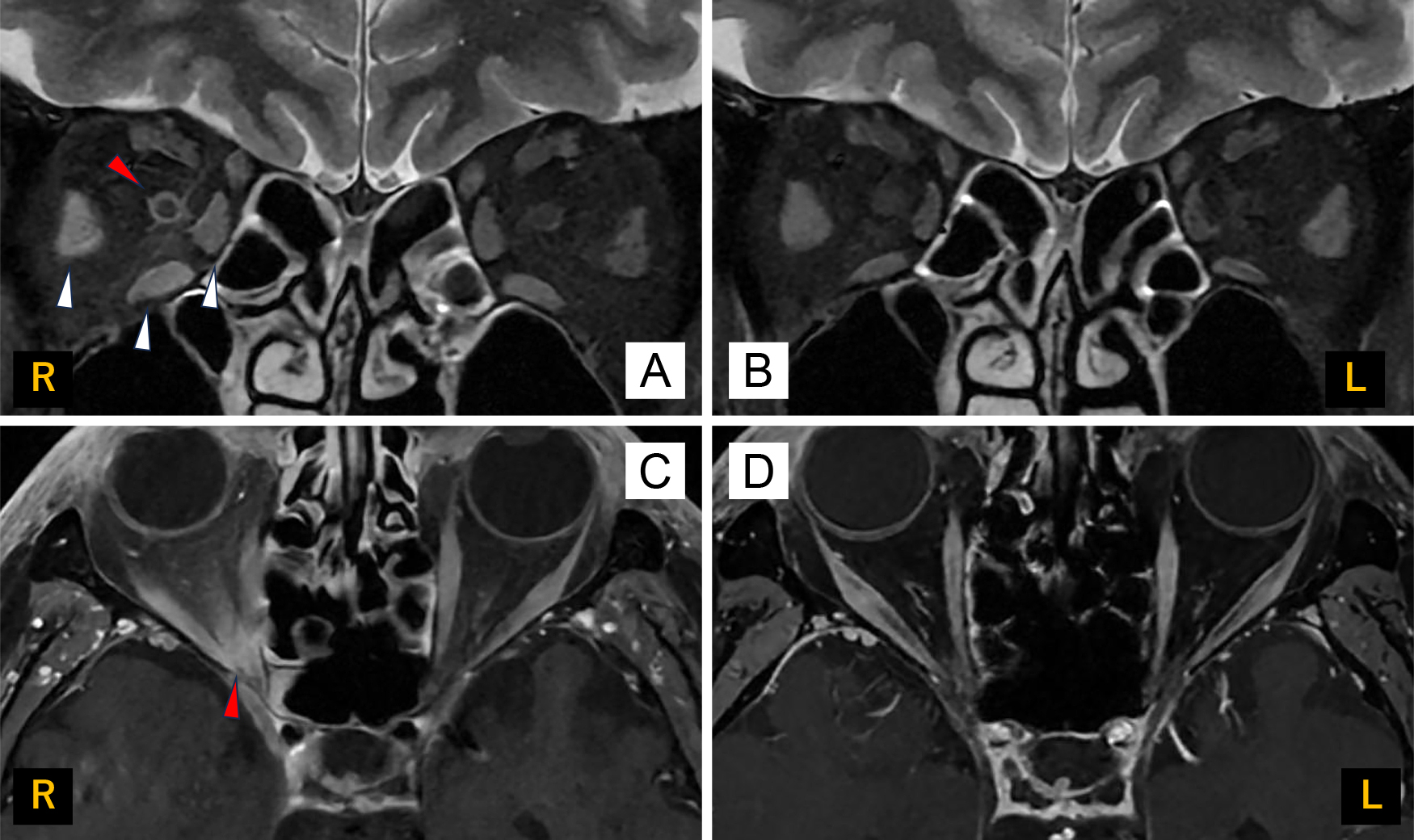 皮疹消退後に複視と視神経障害を呈し，良好な転帰を得た眼部帯状疱疹の1例