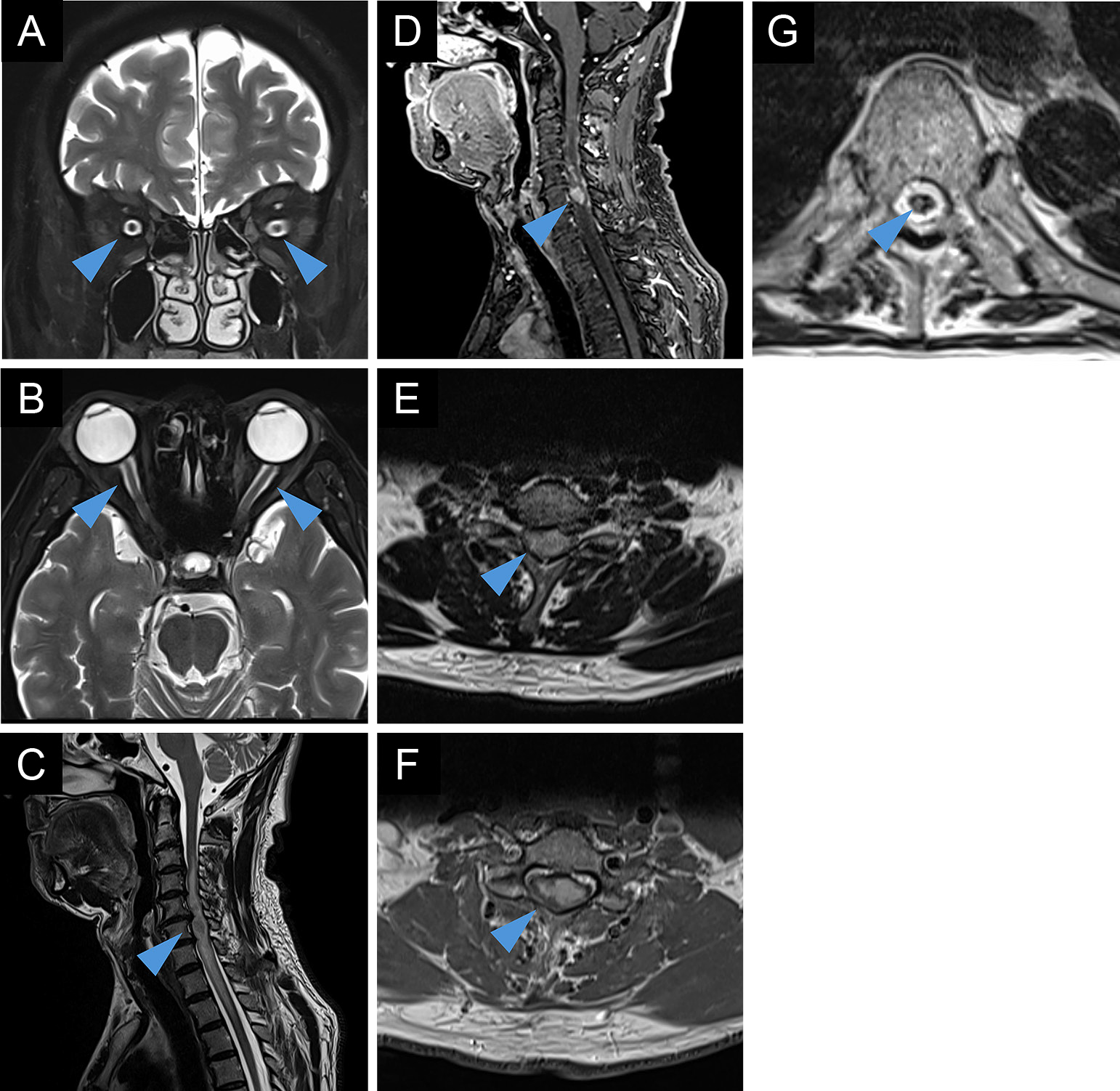 Clinical features of three cases of neurosarcoidosis with a positive aquaporin-4 antibody requiring differentiation from neuromyelitis optica spectrum disorder