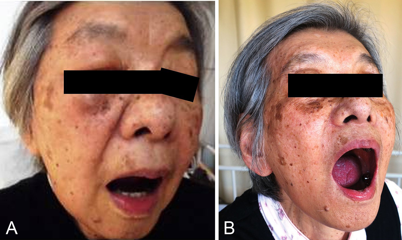 副腎皮質ステロイド剤が著効した急性咀嚼筋炎の1例