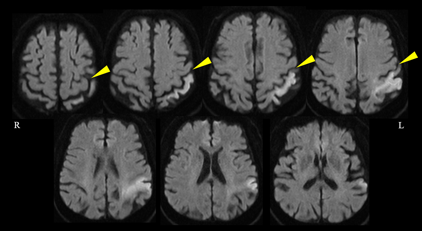 左頭頂葉梗塞により肢節運動性失行と皮膚書字覚障害・立体感覚障害を両‍側に呈した1例