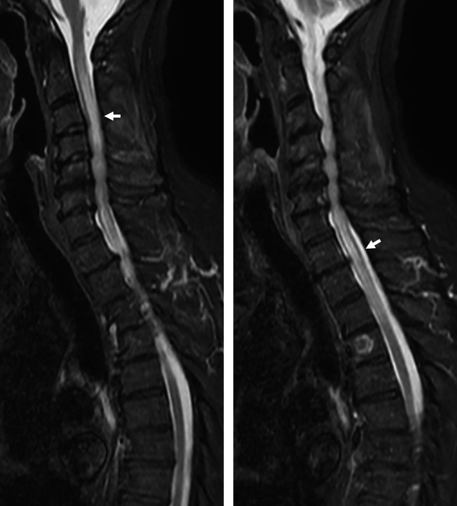 ステロイド反応性の遅発性脊髄長大病変をともなったクリプトコッカス髄‍膜脳炎の1例