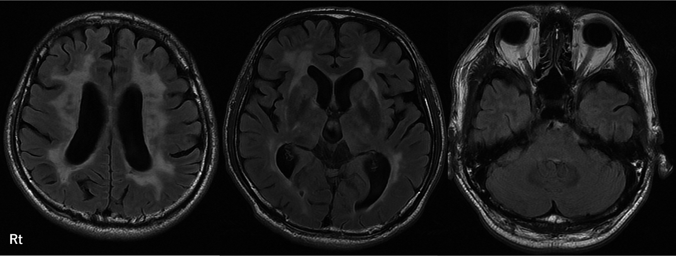 “Chocolate Chip Sign” が診断に有用であったhigh temperature requirement A serine peptidase 1（HTRA1）関連脳小血管病の57歳男性例