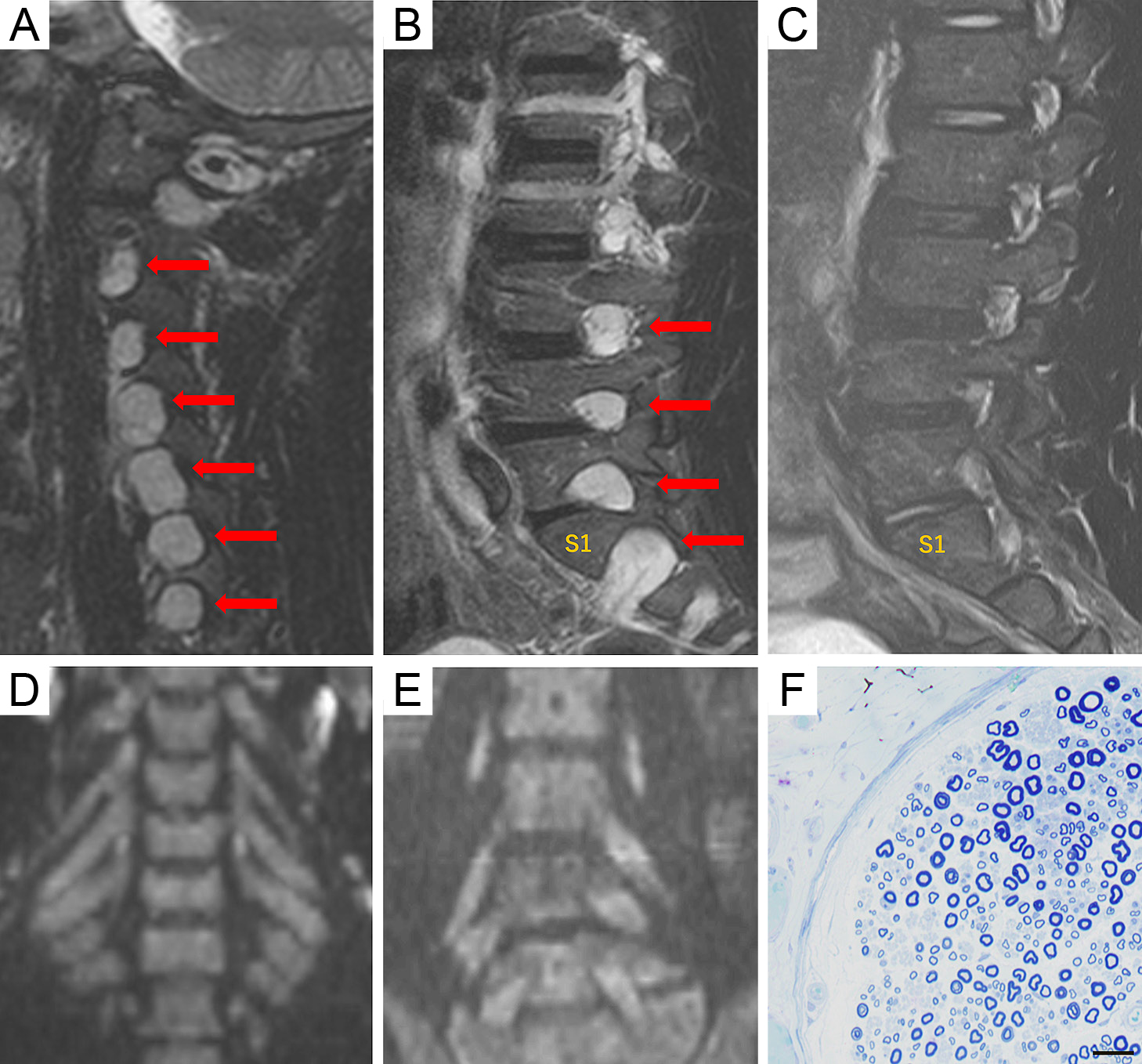 抗neurofascin 155抗体陽性自己免疫性ノドパチー症例に認めた著明な脊‍髄神経根肥厚