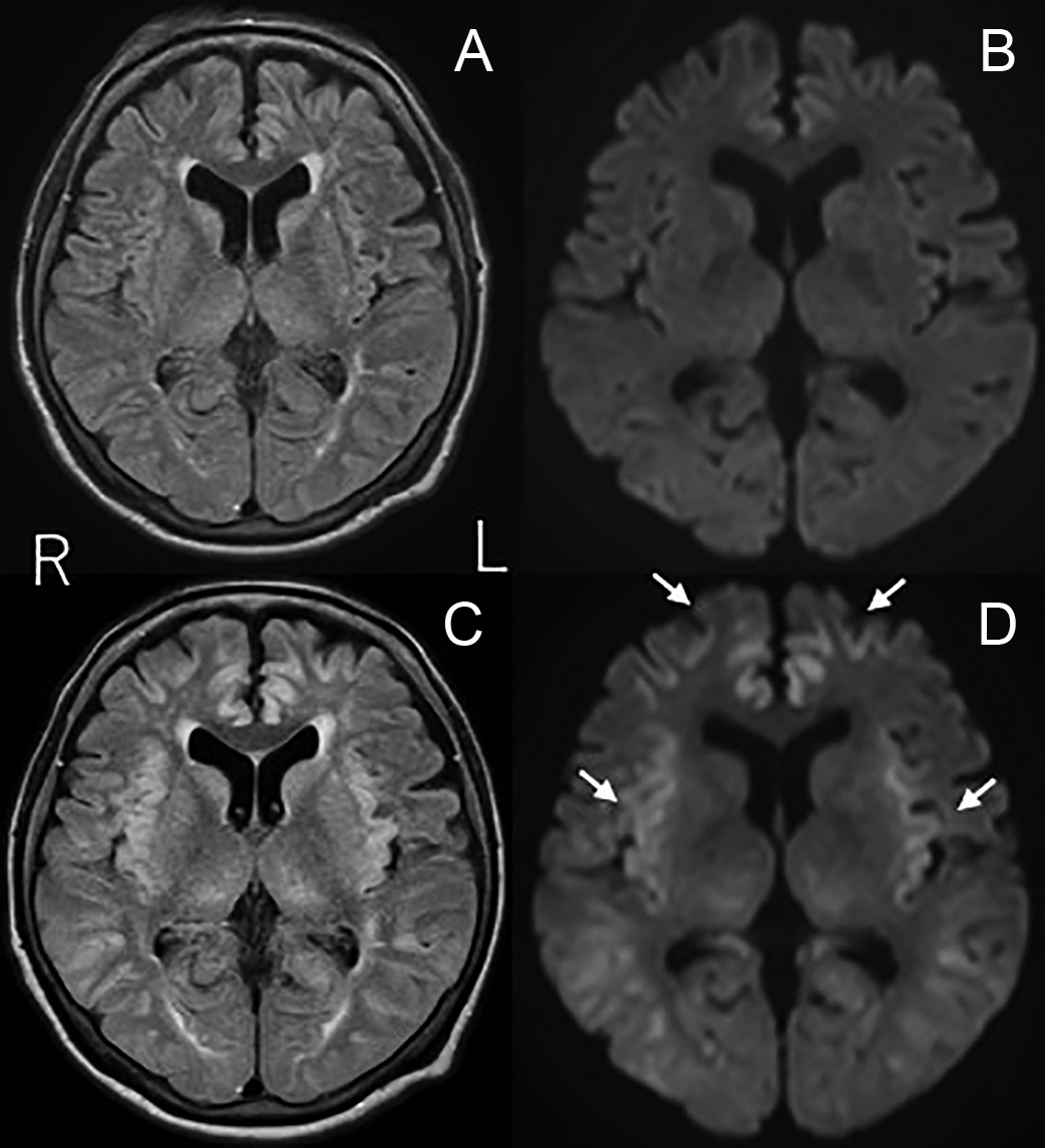 発症当初血中アンモニアが正常であった成人発症II型シトルリン血症の71歳女性