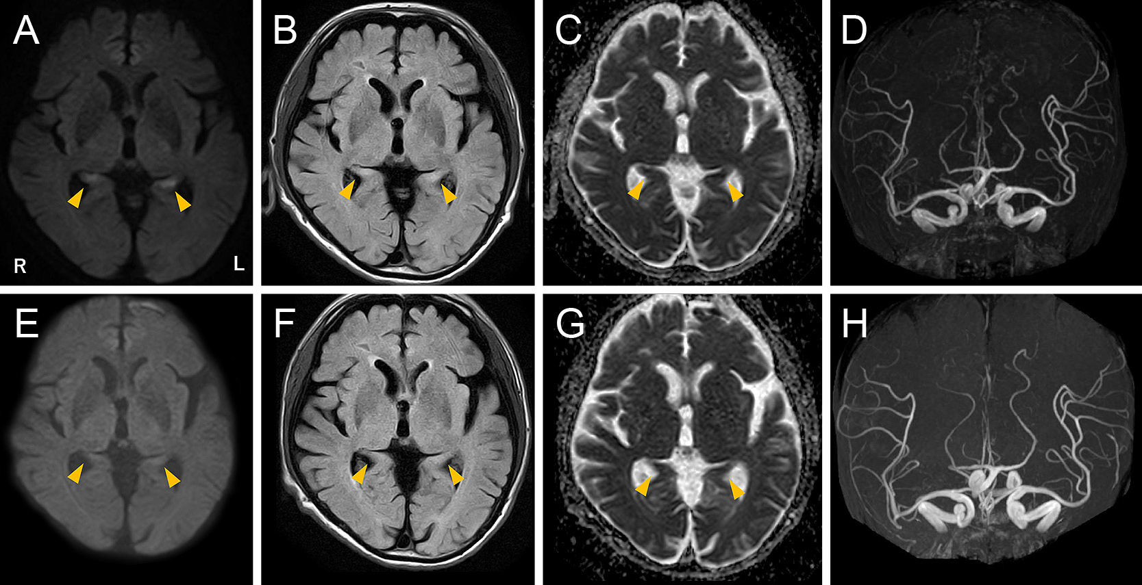 両側海馬の血管性浮腫と一過性前向性健忘を認めた敗血症関連脳症の1例