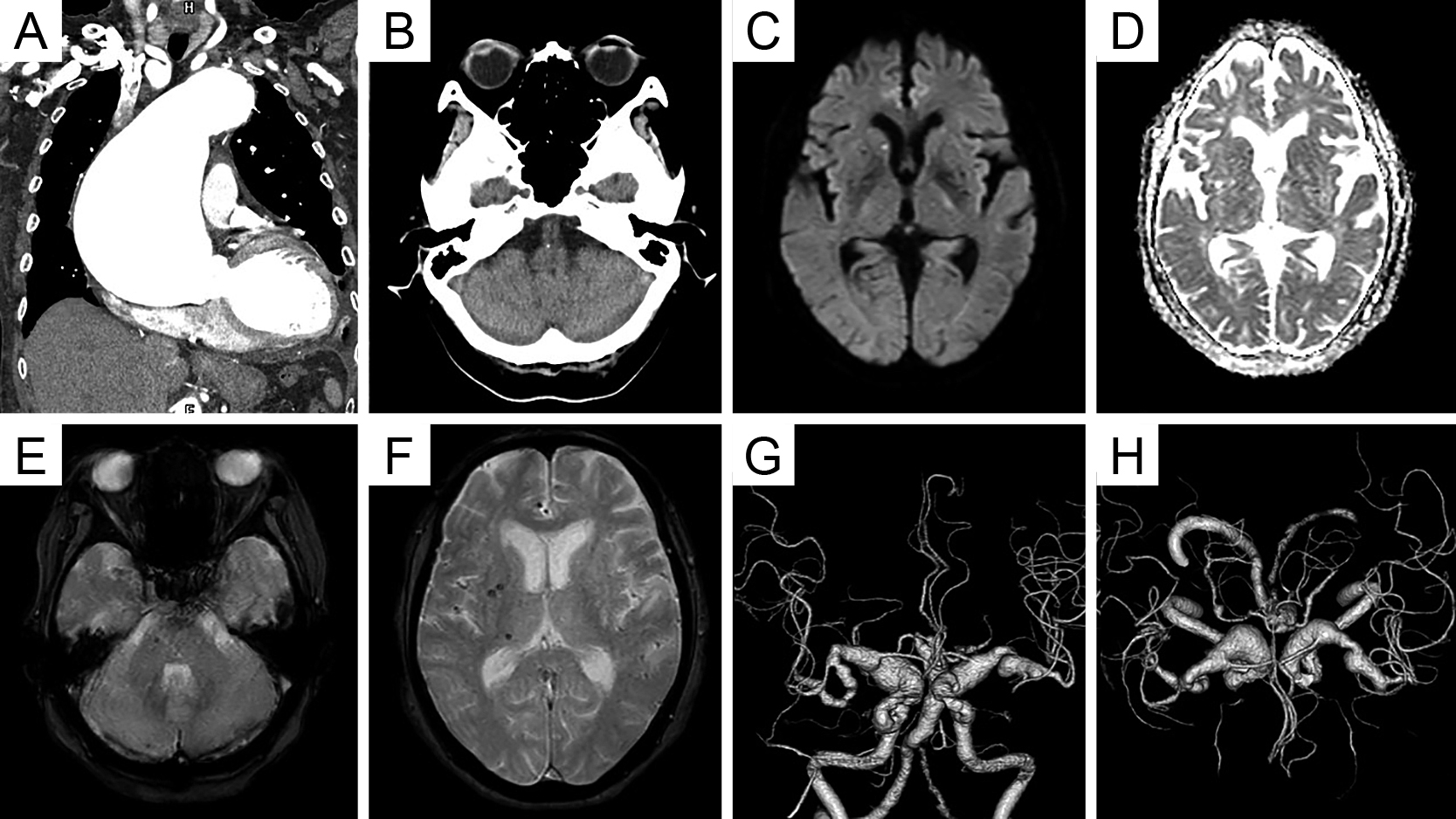 Dolichoectasia Involving Both Anterior and Posterior Circulations: A ‍Case Report and Literature Review