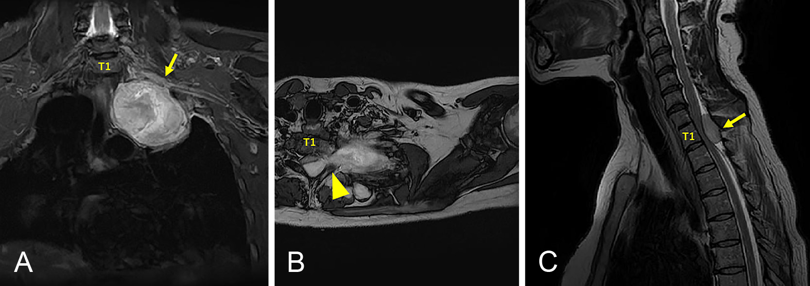 神経線維腫症1型に合併した悪性末梢神経鞘腫瘍によりPancoast症候群を呈した1例
