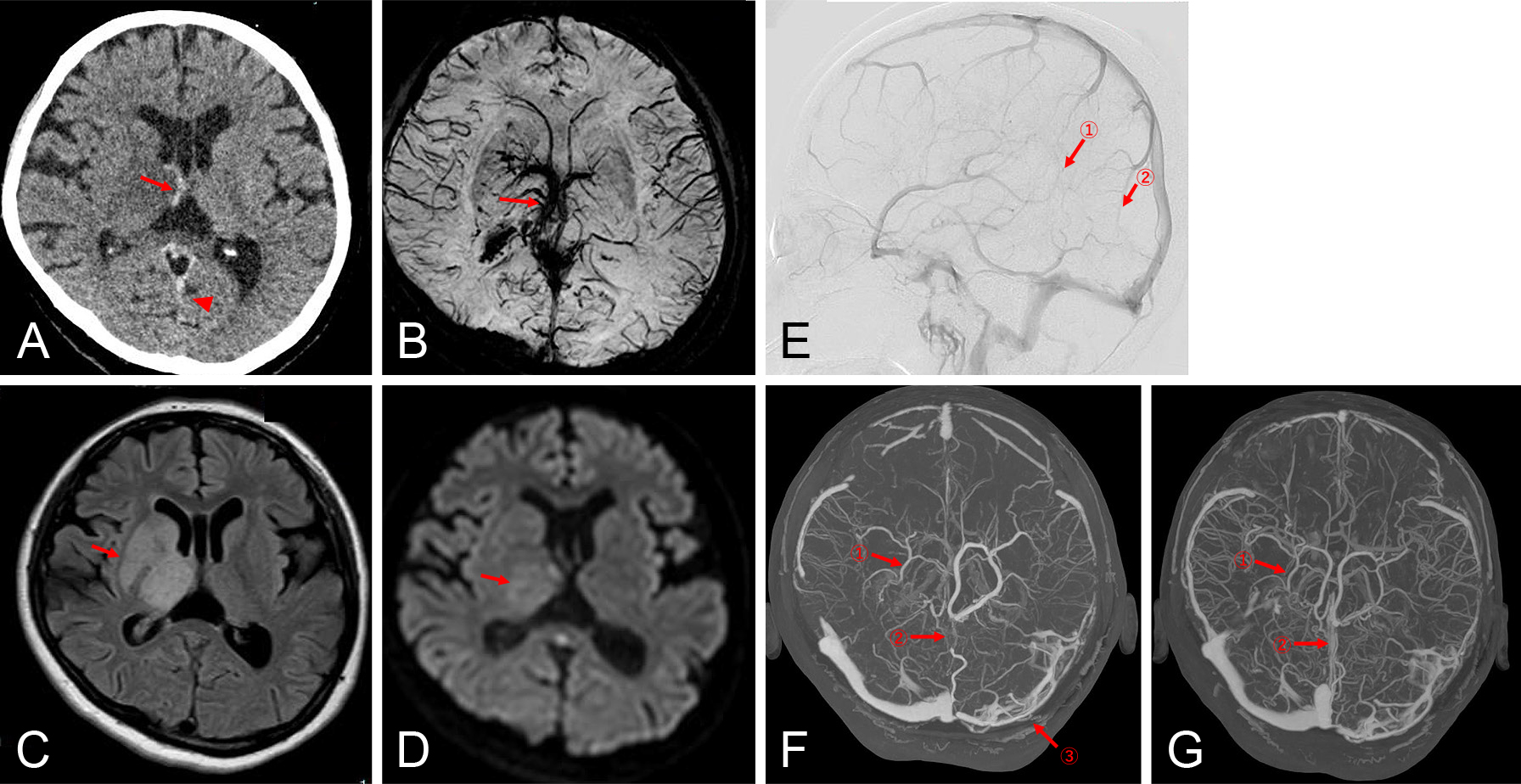 トロンボポエチン受容体作動薬療法長期経過中に生じた脳静脈洞血栓症の1例