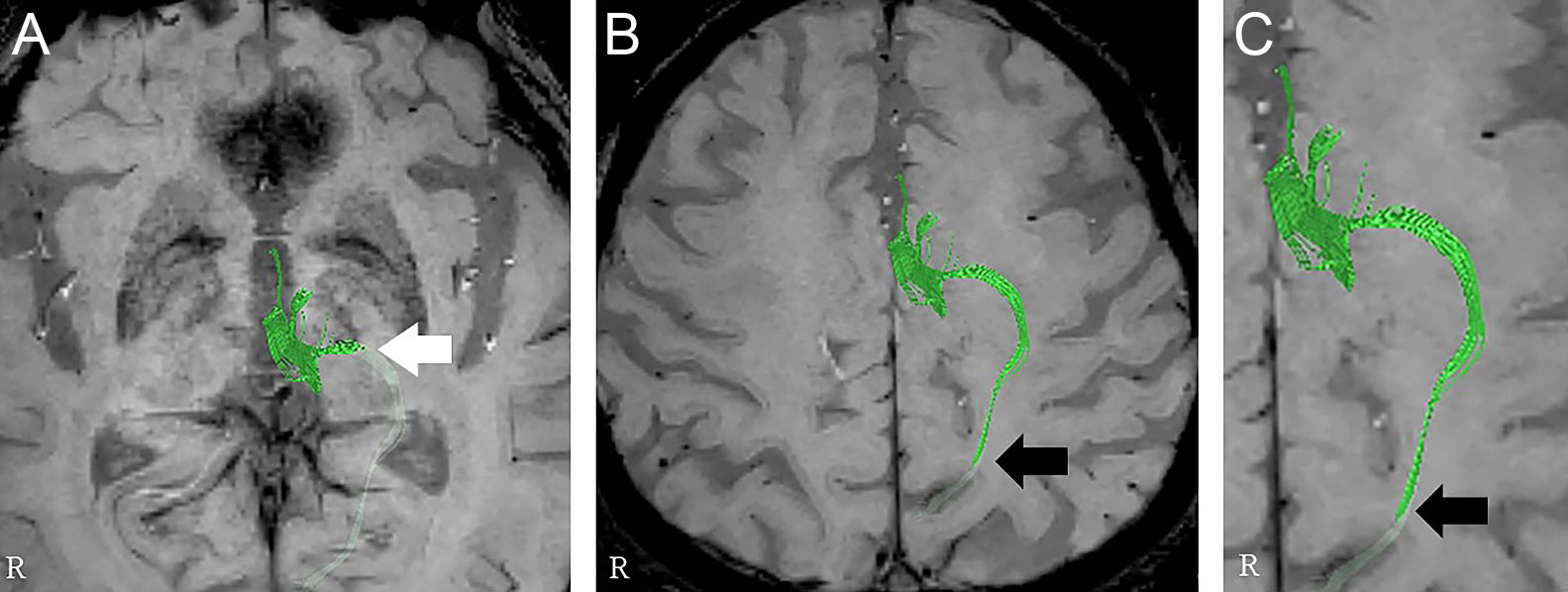 Delayed dysgeusia in five patients following MRI-guided focused ultrasound surgery targeting the ventral intermediate nucleus of the ‍thalamus for essential tremor