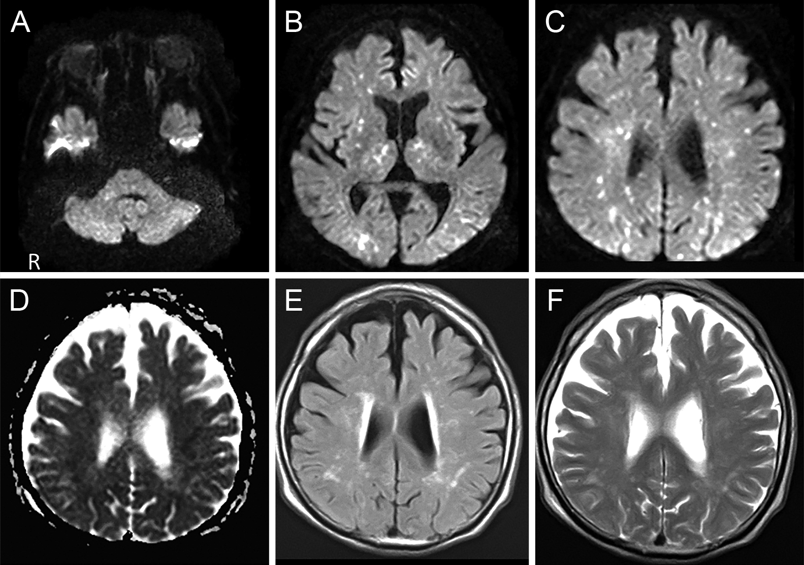 頭部MRI所見の経時的変化を捉えた予後不良の脳脂肪塞栓症の1例