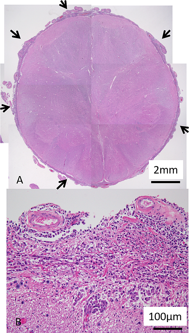 難治性頸部痛を主徴とし，生前診断が困難であったびまん性髄膜浸潤・播‍種を伴う膠芽腫の1剖検例