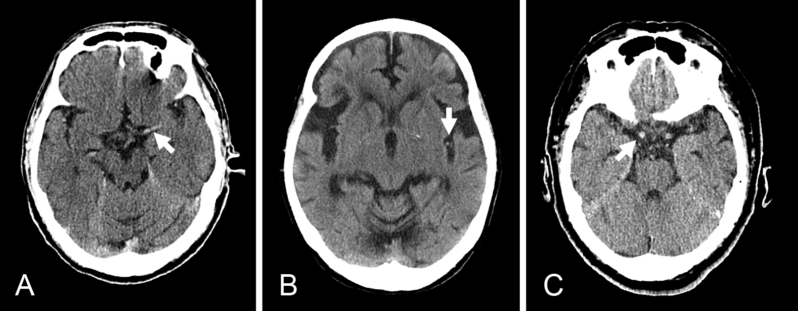 脳卒中急性期診療における画像診断の最前線：CT，MRI，灌流画像，そしてAI解析の臨床応用と課題