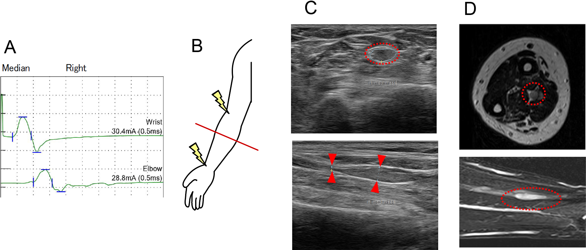 約30年の経過で多発単神経障害を来し，馬尾多発結節の指摘を契機にschwannomatosisと診断し得た1例
