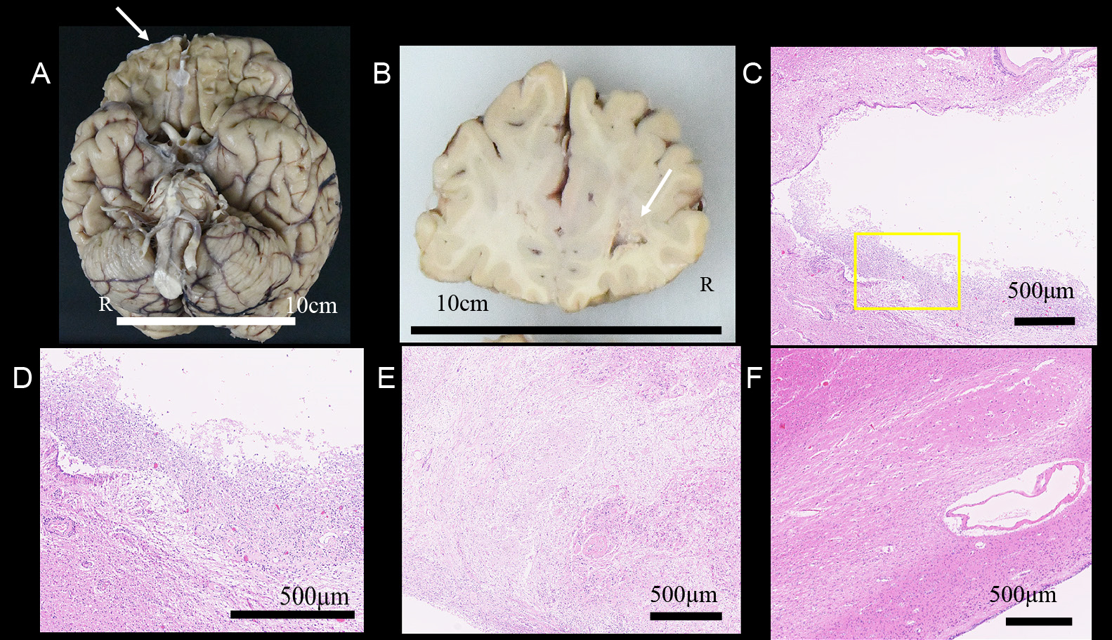 乳癌治療中に脳膿瘍とサイトメガロウイルス脳炎を同時に発症した1例