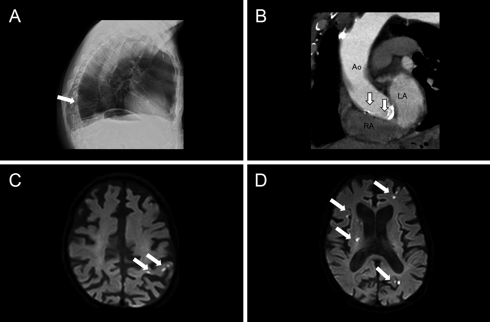 潜因性脳梗塞として経過観察中にplatypnea-orthodeoxia症候群と発作性心房細動が明らかになった1例