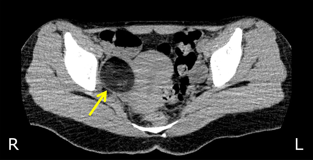 卵巣成熟奇形腫を合併した抗NMDA受容体抗体陰性自己免疫性脳炎に対して早期の腫瘍摘出術が奏効した18歳女性例
