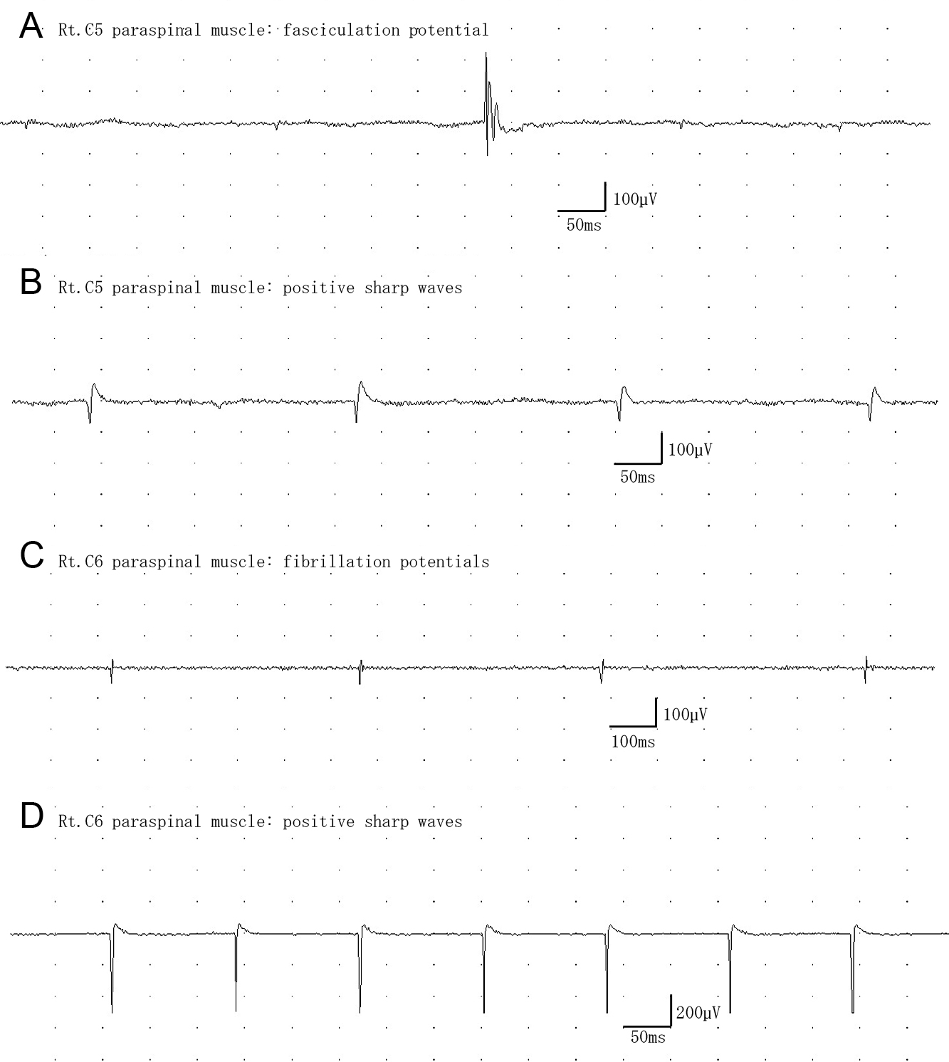 針筋電図が診断に寄与した近位型頸椎症性筋萎縮症の1例