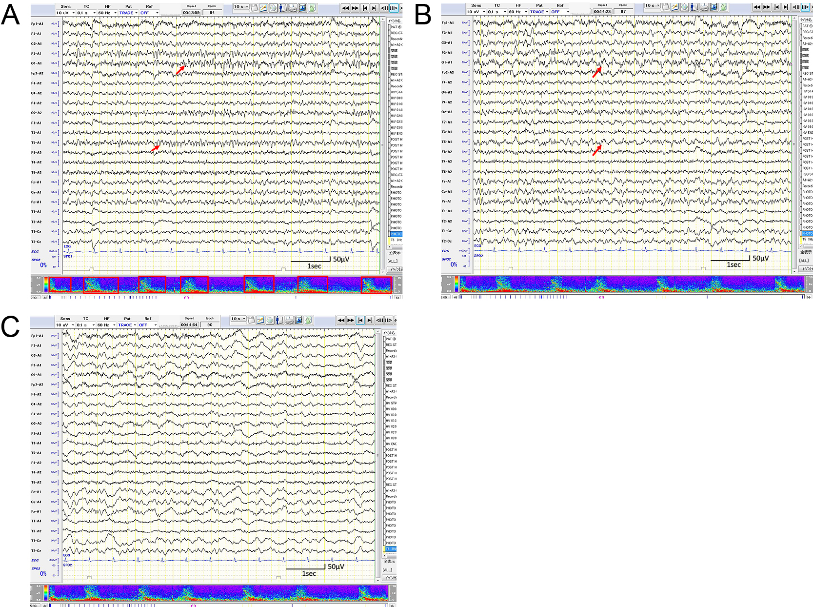 てんかん発作症状がなくelectrographic seizureのみを認めた抗leucine-rich, glioma-inactivated 1（LGI1）抗体陽性自己免疫性脳炎の1例