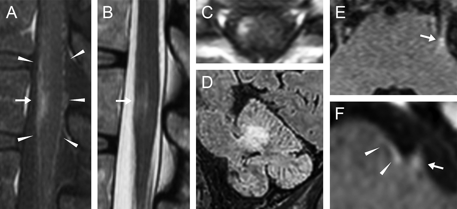 A case of myelin oligodendrocyte glycoprotein antibody-associated disease presenting with radiculopathies