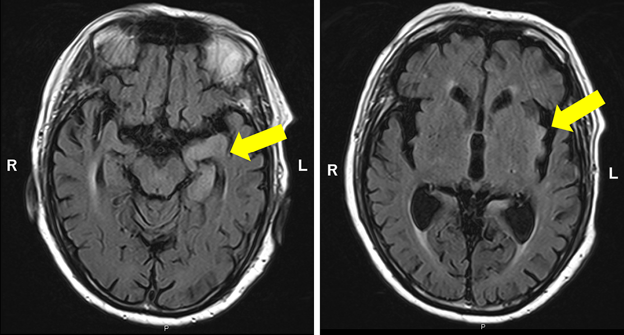 慢性炎症性脱髄性多発神経根炎でステロイドを投与中にヒトヘルペスウイルス6A脳炎を発症した89歳男性の症例