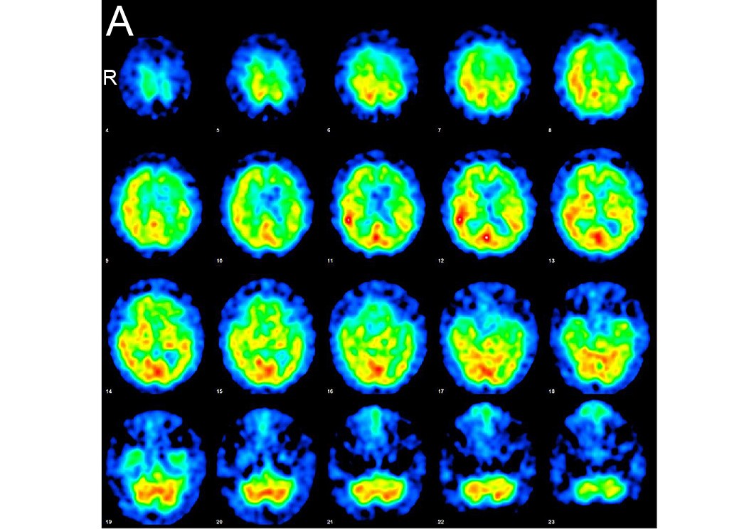 歌唱能力が保たれた非流暢性・失文法型進行性失語を呈した進行性核上性麻痺の1例