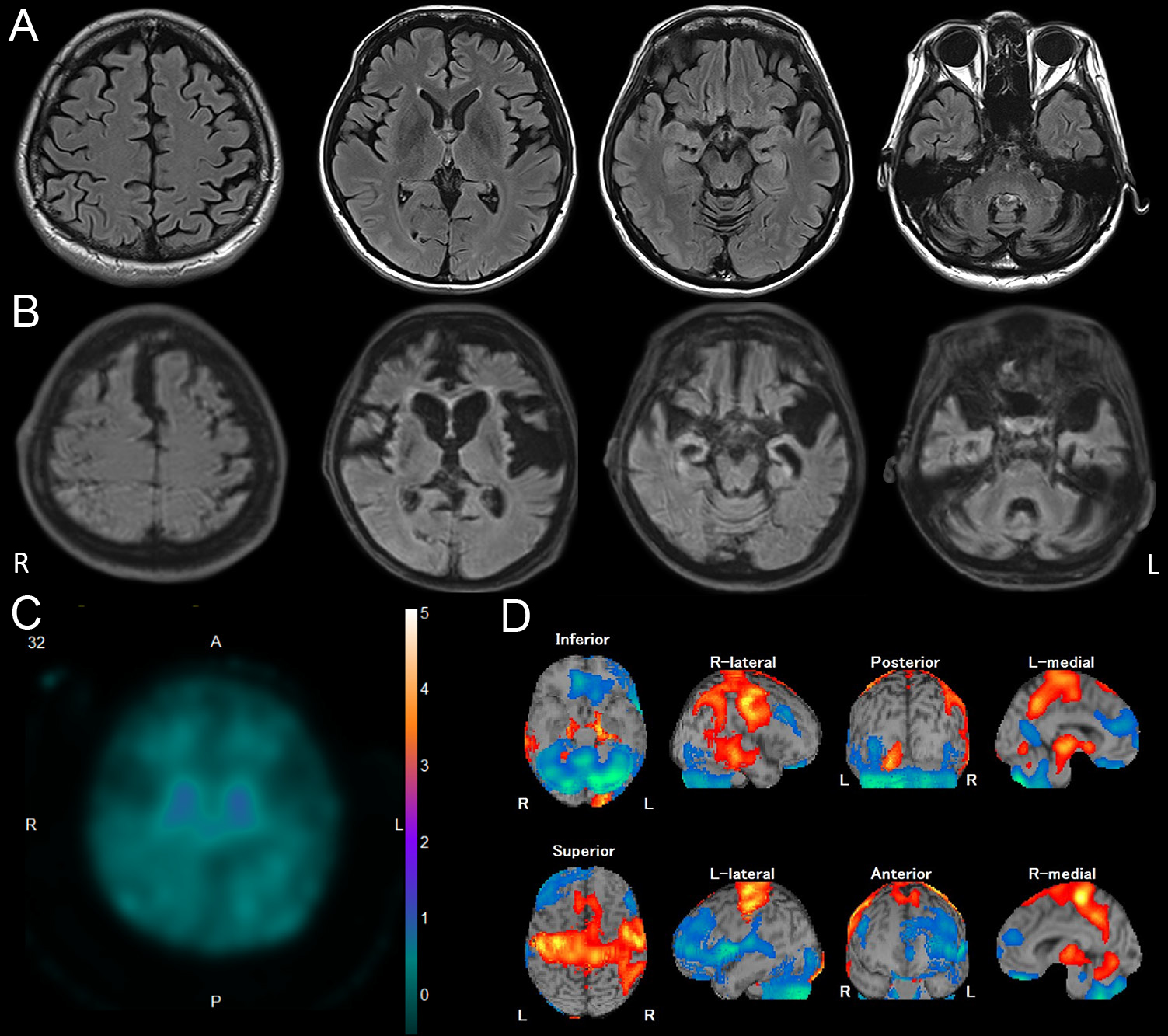 小児期に発症し49歳までの長期経過を観察し得たホスホリパーゼA2group6関連神経変性疾患女性例